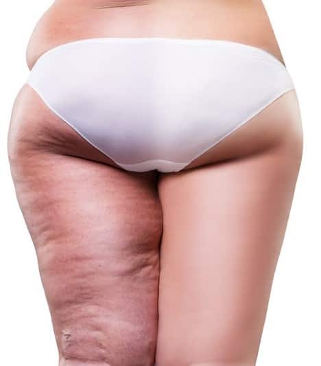 What is Cellulite