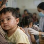 child with measles in clinic care